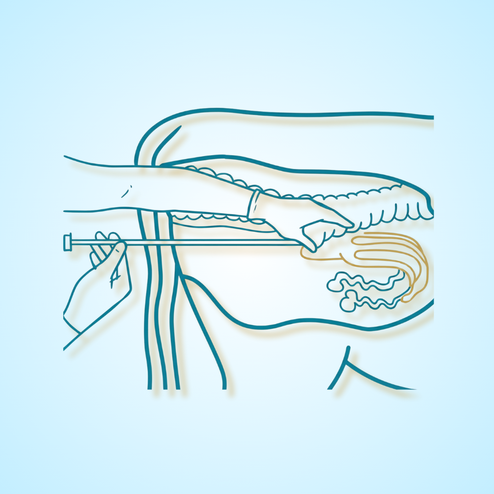 Inseminação Artificial (IATF)